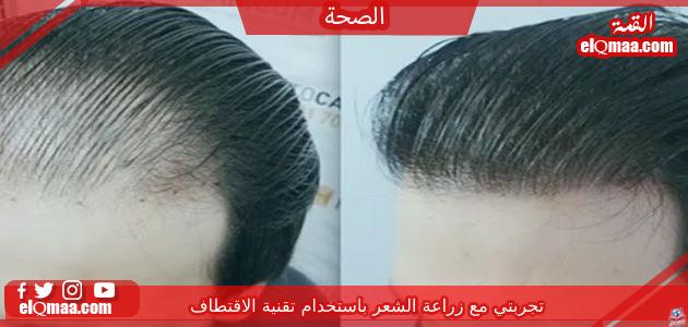 تجربتي مع زراعة الشعر باستخدام تقنية الاقتطاف