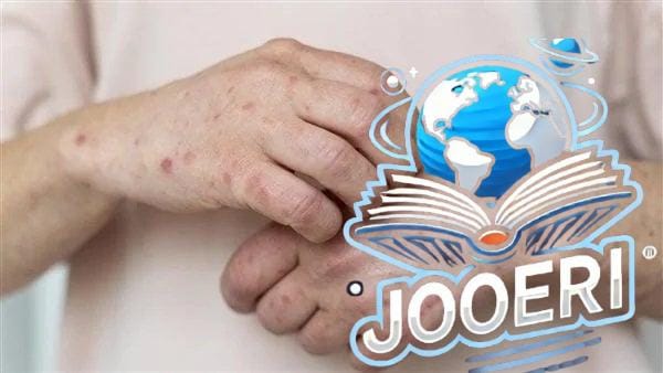ظهور أول حالة إصابة بجدري القرود في الولايات المتحدة الأمريكية