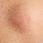 إزالة الأورام الدهنية - الأورام الشحمية على الظهر: ماذا تفعل بشأن الكتل المزعجة؟