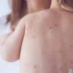 القضاء على الحصبة بالمملكة قبل حلول 2028.. صورة للأعراض والوقاية يبرزها مختص