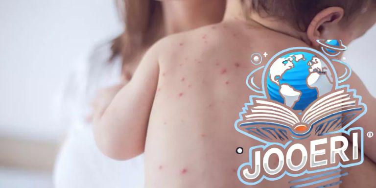 القضاء على الحصبة بالمملكة قبل حلول 2028.. صورة للأعراض والوقاية يبرزها مختص