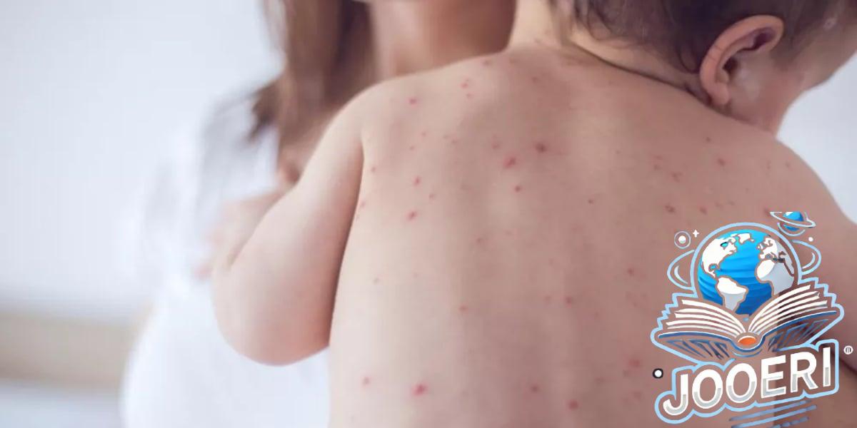 القضاء على الحصبة بالمملكة قبل حلول 2028.. صورة للأعراض والوقاية يبرزها مختص