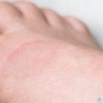 تغيرات جلدية على شكل حلقة - الورم الحبيبي الحلقي: كيفية التعرف على المرض الجلدي وعلاجه