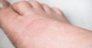 تغيرات جلدية على شكل حلقة - الورم الحبيبي الحلقي: كيفية التعرف على المرض الجلدي وعلاجه