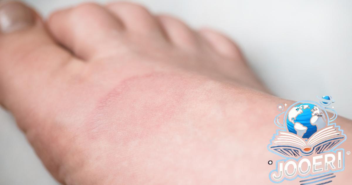 تغيرات جلدية على شكل حلقة - الورم الحبيبي الحلقي: كيفية التعرف على المرض الجلدي وعلاجه