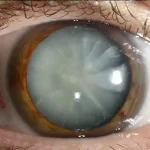 طبيب يحذر: هذه أعراض المياه البيضاء في العين