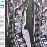 مستشفى الدكتور سليمان الحبيب بالقصيم يُجري عملية نوعية عن طريق الفم لإنهاء معاناة خمسيني مع الشلل