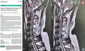 مستشفى الدكتور سليمان الحبيب بالقصيم يُجري عملية نوعية عن طريق الفم لإنهاء معاناة خمسيني مع الشلل