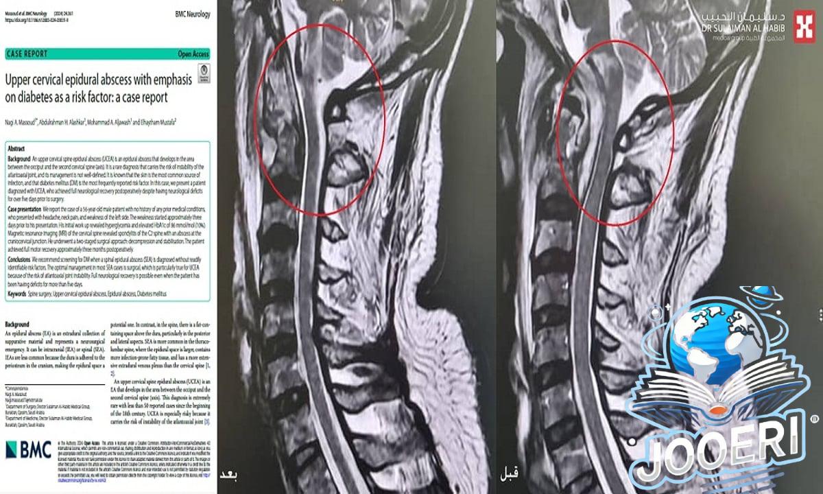 مستشفى الدكتور سليمان الحبيب بالقصيم يُجري عملية نوعية عن طريق الفم لإنهاء معاناة خمسيني مع الشلل